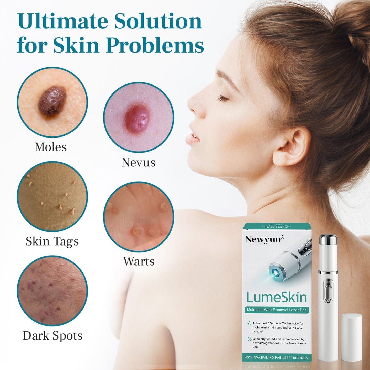 Newyuo® LumeSkin Mole and Wart Removal Laser Pen