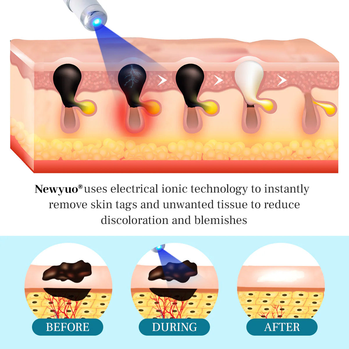 Newyuo® LumeSkin Mole and Wart Removal Laser Pen