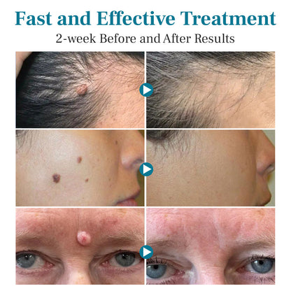 Newyuo® LumeSkin Mole and Wart Removal Laser Pen