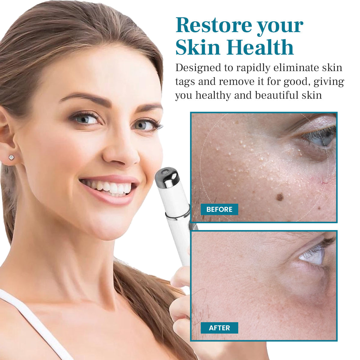 Newyuo® LumeSkin Mole and Wart Removal Laser Pen
