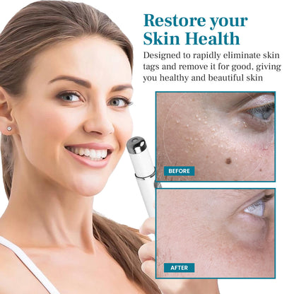 Newyuo® LumeSkin Mole and Wart Removal Laser Pen